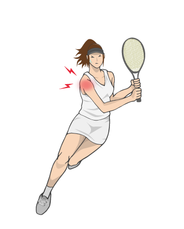 テニスで肩を痛めた女性